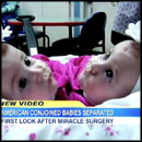 Conjoined Twins Get an Amazing Christmas Blessing