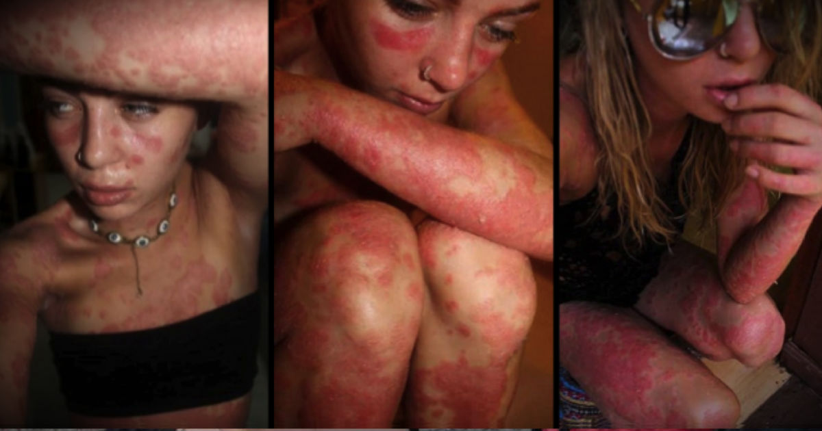 People Stare At Her Rash Covered Body. What She’s Doing About It - INCREDIBLE!