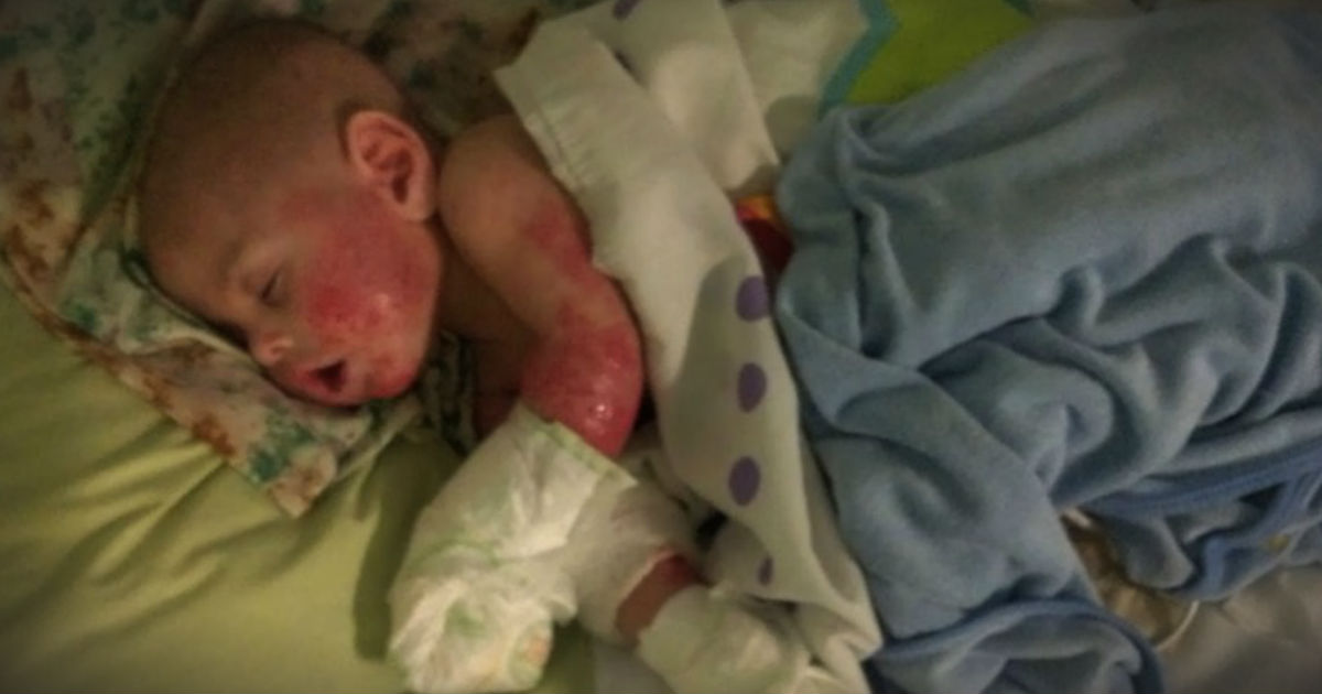 Her Baby’s Skin Was Melting Off. Then Her Mom Instincts Saved The Day!