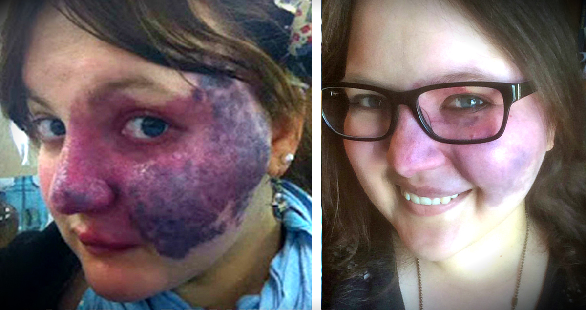 Brave Woman Uses The Birthmark Bullies Targeted To Inspire!