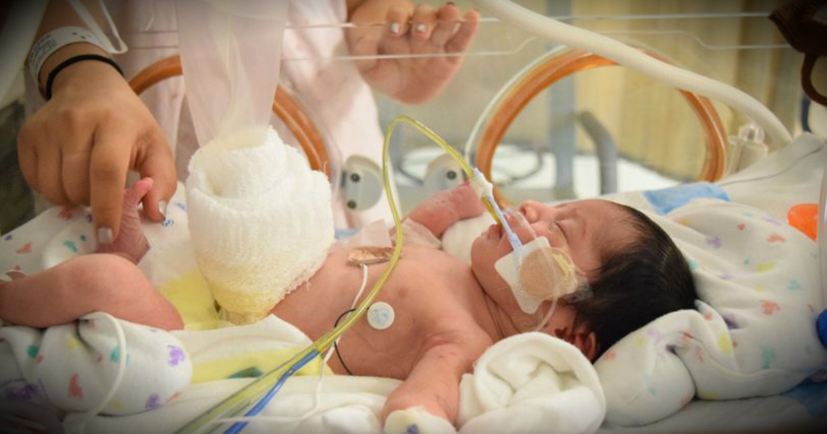 Miracle Baby Born With Intestines Outside Of Body Saved By Plastic Bag